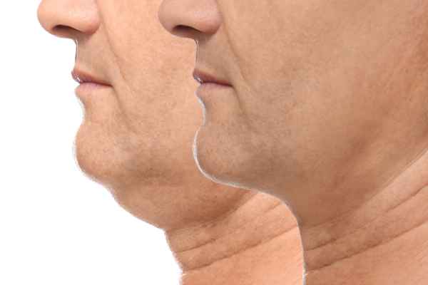 HIFU - Breakthrough in Anti - ageing 2 hifu results Sunbury Common