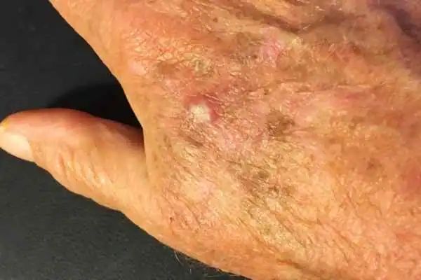 Image of Actinic keratoses Sunbury Common on a person hand